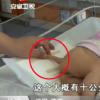 엉덩이에 ‘꼬리’달고 태어난 中신생아
