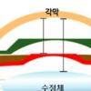 안내렌즈삽입술…“눈 속 어느 부위에 삽입하는 걸까?”