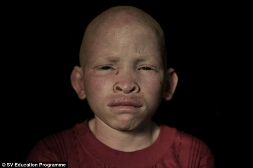 탄자니아 알비노 환자