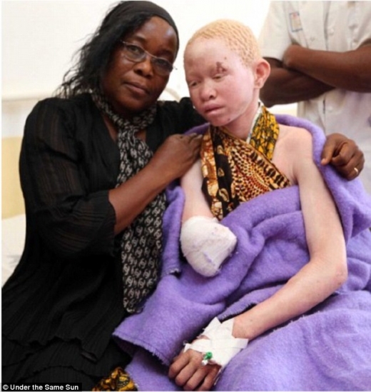 탄자니아 알비노 환자