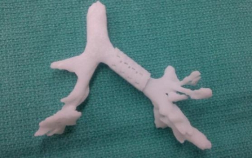 3D 프린터로 출력한 기관지 특수 스탠트