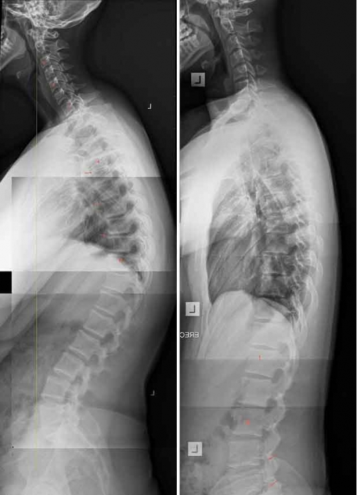 척추까지 영향을 미친 10대의 치료 전(왼쪽)과 후