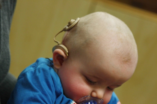 인공와우 이식수술 받은 아기.