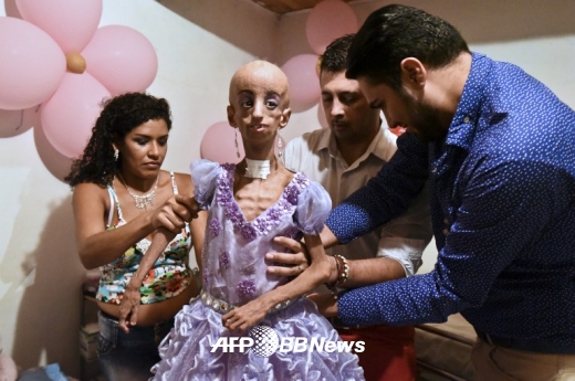 콜롬비아의 조로증 소녀가 15세 생일을 맞아 가족의 도움으로 드레스를 입고 있다.