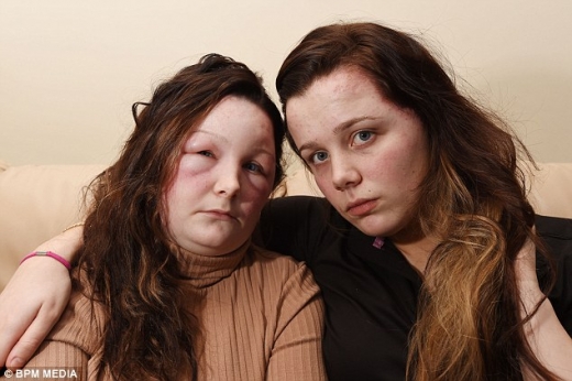 모발 염색 부작용으로 고통받고 있는 에이미(좌)와 조디(우) 자매