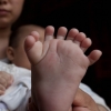 손가락, 발가락 모두 31개…中 ‘문어손’ 아이 태어나
