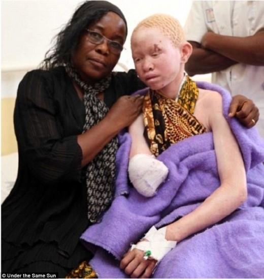 탄자니아 알비노 환자(오른쪽)