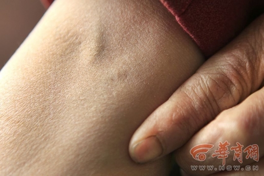 십여 년 전 매혈을 한 흔적이 아직도 남아있다. (사진=화상보)