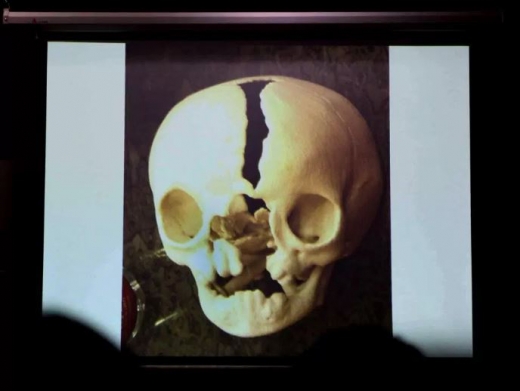 2010년 6월 병원에서 찍은 휘캉의 엑스레이 사진이다.