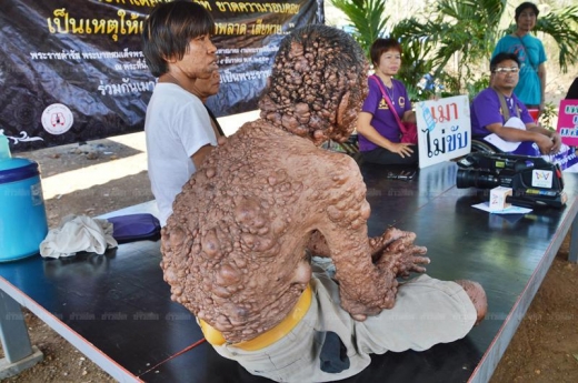 실제 그의 온 몸을 뒤덮고 있는 종양들.