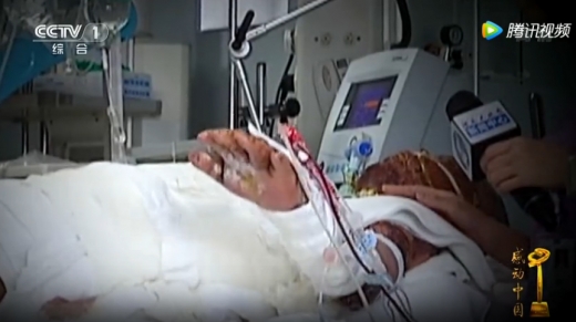 4차례의 피부이식 수술 뒤 기운을 차리며 방송 카메라 앞에 손을 흔들어 보이는 왕씨의 모습. (사진=CCTV)