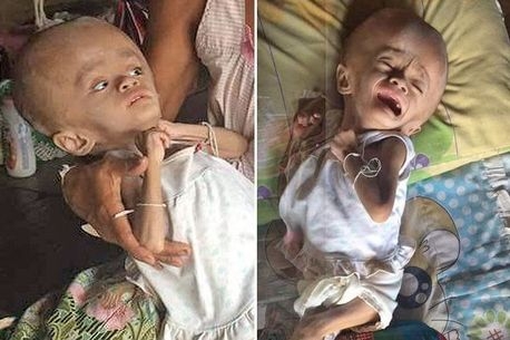 지나치게 발달된 머리에 비해 팔다리는 정상적으로 발육하지 못했다.