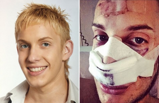 왼쪽 사진은 수술받기전 16세 였을 당시, 오른쪽 사진은 2015년 두번째 코 수술을 받은 후.