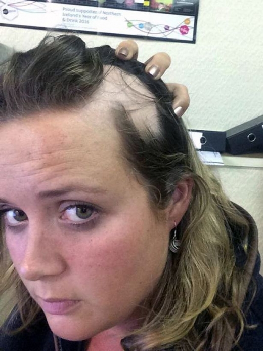 원형탈모증은 환경적 요인의 복합적인 작용에 의해 모낭의 면역체계에 이상이 생겨 나타난다.