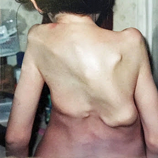 그녀가 11살 때, 몸 안에 또다른 뼈들이 자라나기 시작했다. (사진=메트로)