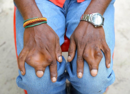 많은 이웃들이 손을 정상으로 되돌려야한다고 완곡하게 말해도 수술을 받으면 무언가 나쁜 일이 생길것만 같다는 칸나쑤 가문. (사진=더썬) 