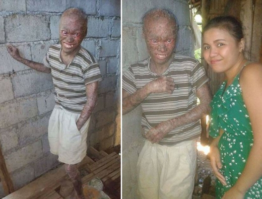 안토니오와 그의 사촌은 치료를 통해 사람들의 대우가 달라졌으면 하는 작은 희망을 갖고 있다.