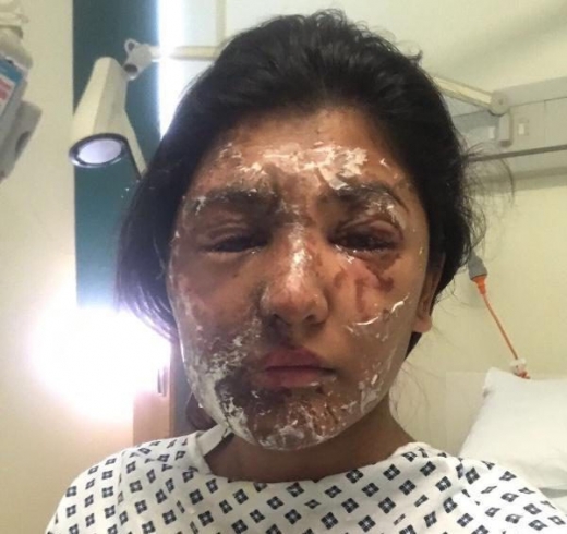 칸은 생명은 건졌지만 전신화상을 입고 치료를 받고 있다. (사진=더선 캡처)