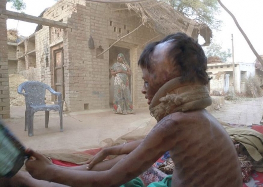 줄리는 얼굴, 팔과 목, 가슴에 심각한 화상을 입었지만 가난 때문에 어떤 치료도 받지 못했다. (사진=데일리메일 캡쳐)