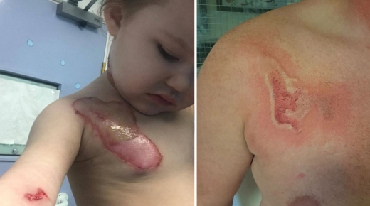 아빠 카일은 딸의 오른쪽 가슴에 있는 흉터 모양의 문신을 같은 위치에 새겼다. (사진=메트로, 키즈스팟)