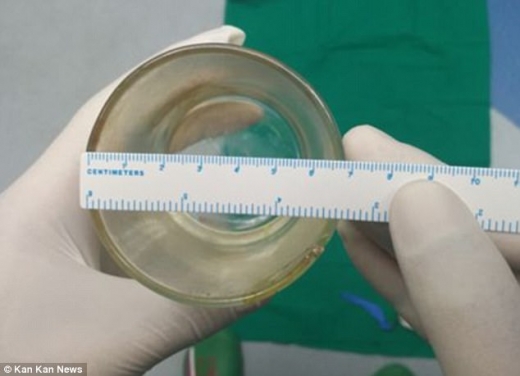 의사가 장 씨의 직장에서 꺼낸 컵의 크기를 직접 재보고 있다.