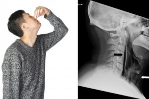 “재채기할 때 코·입 막으면 식도 근처 파열될 수 있다”