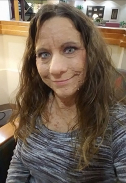 치료를 시작한 뒤 얼마 지나지 않았을 당시 허퍼의 모습