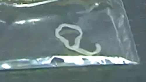 실제 여성의 가슴 쪽에 있던 촌충