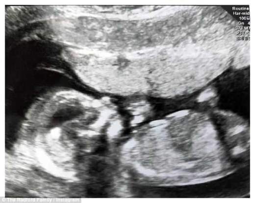 21번째 아기의 초음파 사진.