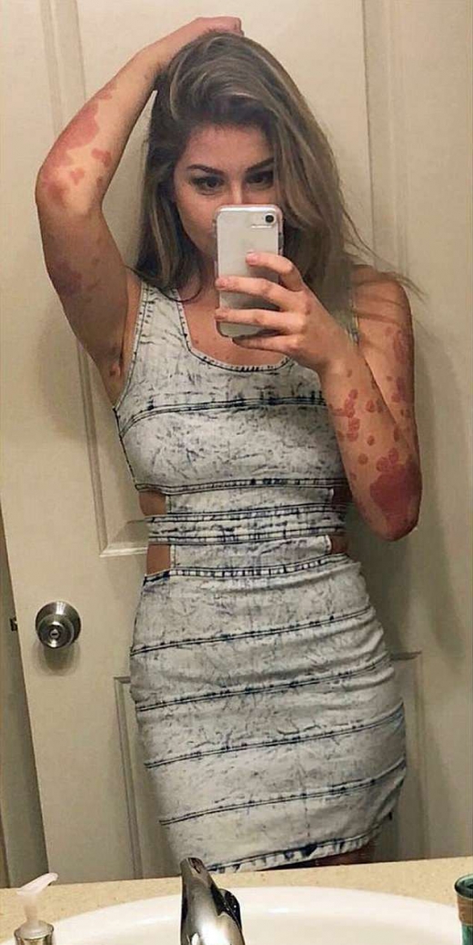 중증 건선을 앓고 있는 카트리나 데자르댕(21)