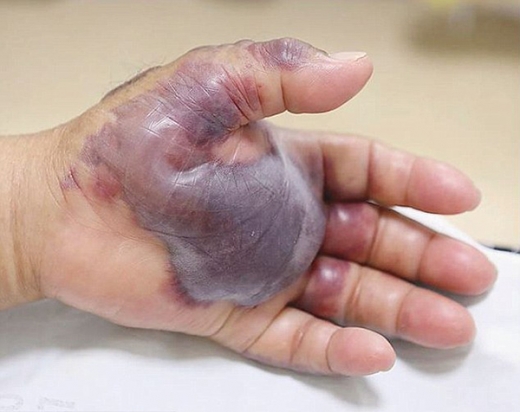 실제로 멍이 들고 부풀어오른 손. (사진=뉴잉글랜드저널오브메디슨)