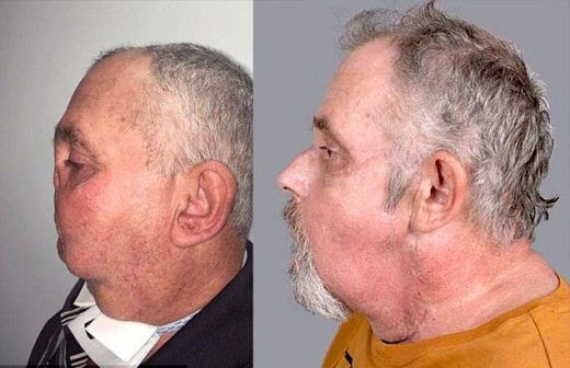 왼쪽은 수술 전, 오른쪽은 수술 후 모습