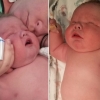 무려 6.75㎏…거의 다 커서 출생한 ‘슈퍼 베이비’