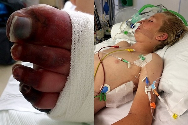 의료진은 미첼에게 강제적 코마라는 극단적 조치를 취했으며, 미첼은 다행히 목숨은 건졌지만 대신 다리를 잃게 됐다.