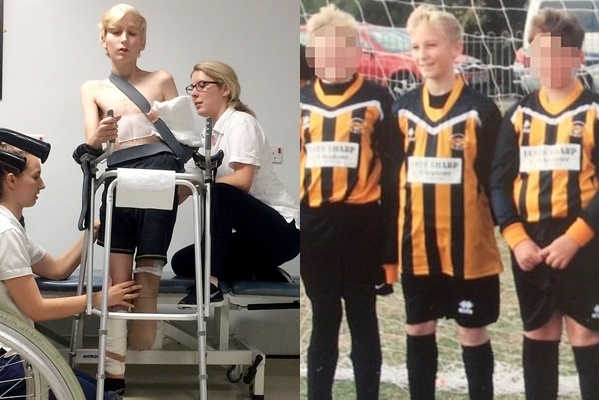 축구를 좋아하던 소년은 다리를 잃었지만 보조기구를 착용하고 걷는 연습에 열중하며 다시 축구를 시작했다.