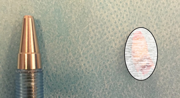 덴마크 50대 남성의 비강에서 발견된 치아 (사진 속 동그라미)