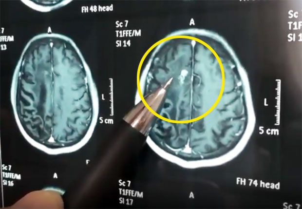 장씨는 이달 초 광저우시 바이윈구의 한 뇌 전문병원을 찾았다가 뜻밖의 이야기를 들었다. 그의 뇌 속에 기생충이 살고 있다는 것./사진=피어비디오