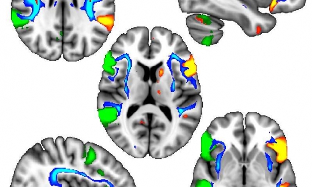 왼손잡이는 뇌 좌반구와 우반구의 언어 관련 영역이 더 조화롭게 상호 작용하는 경향이 있다.(사진=옥스퍼드대)
