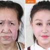 할머니 같았던 ‘조로증’ 中 소녀, 성형수술 후 달라진 얼굴 공개
