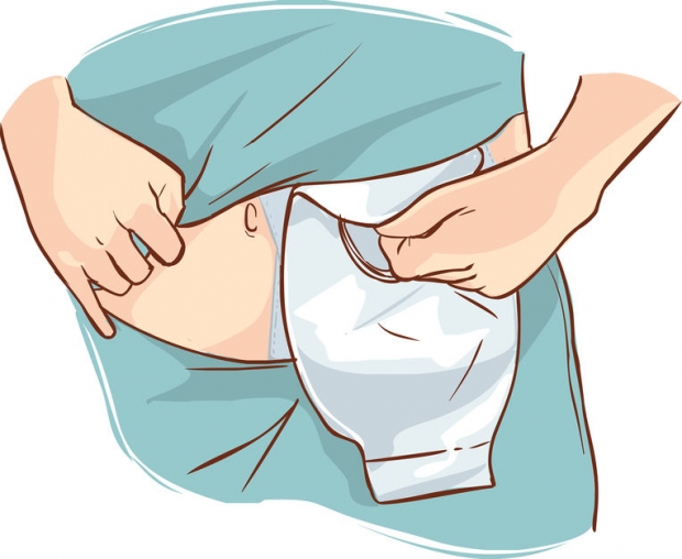 인공항문과 연결된 배변주머니 일러스트 (사진=123rf.com)