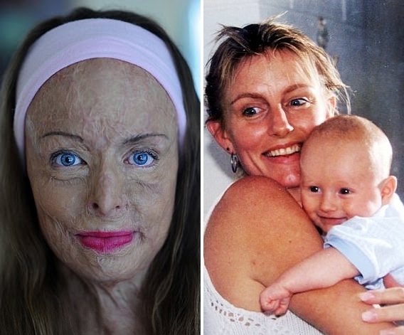 왼쪽은 20년전 불의의 사고로 전신 85%에 화상을 입은 여성이 공개한 초상화 사진, 오른쪽은 사고를 당하기 전 아들과 함께 했던 모습