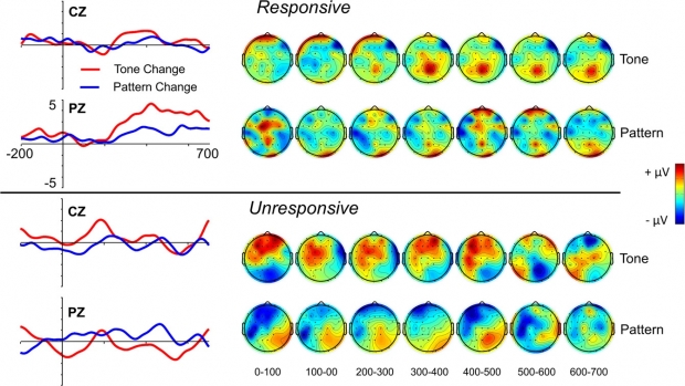 호스피스 환자가 의식이 있을 때(위쪽)와 그렇지 못할 때의 뇌파 변화.(사진=사이언티픽 리포츠)