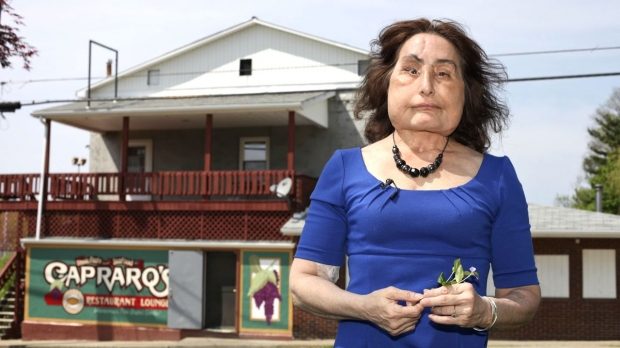 2008년 미국 최초로 안면이식수술(페이스오프 수술)을 받은 지 12년 만인 지난 7월 세상을 떠난 컬프의 생전 모습