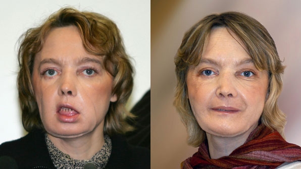 2005년 세계 최초로 안면이식수술을 받았던 프랑스 여성. 이 여성은 수술 후 11년 만인 2016년 사망했다.