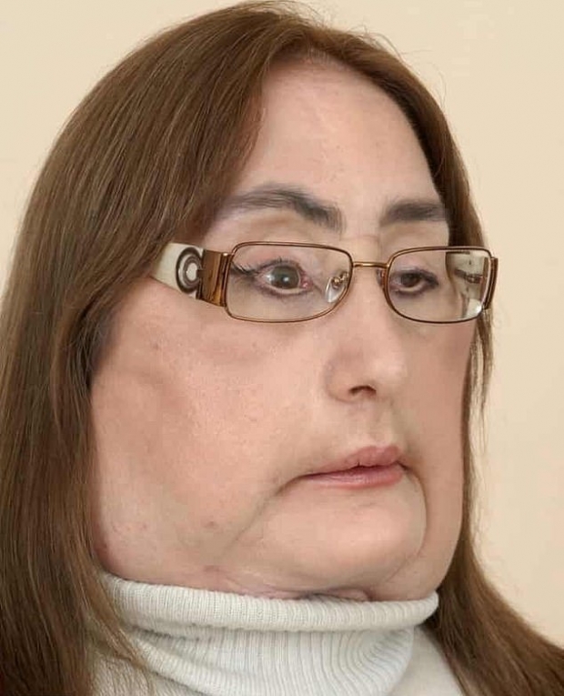 2008년 미국에서 처음으로 안면이식수술을 받은 컬프의 수술 초기 당시 모습