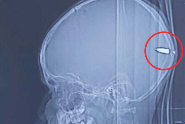 2일(현지시간) 타임스오브이스라엘은 팔레스타인의 한 소년이 머리에 총상을 입고도 기적적으로 살아남았다고 보도했다. 원인 모를 졸음에 시달리던 9살 소년은 수술 후 회복 중이다.