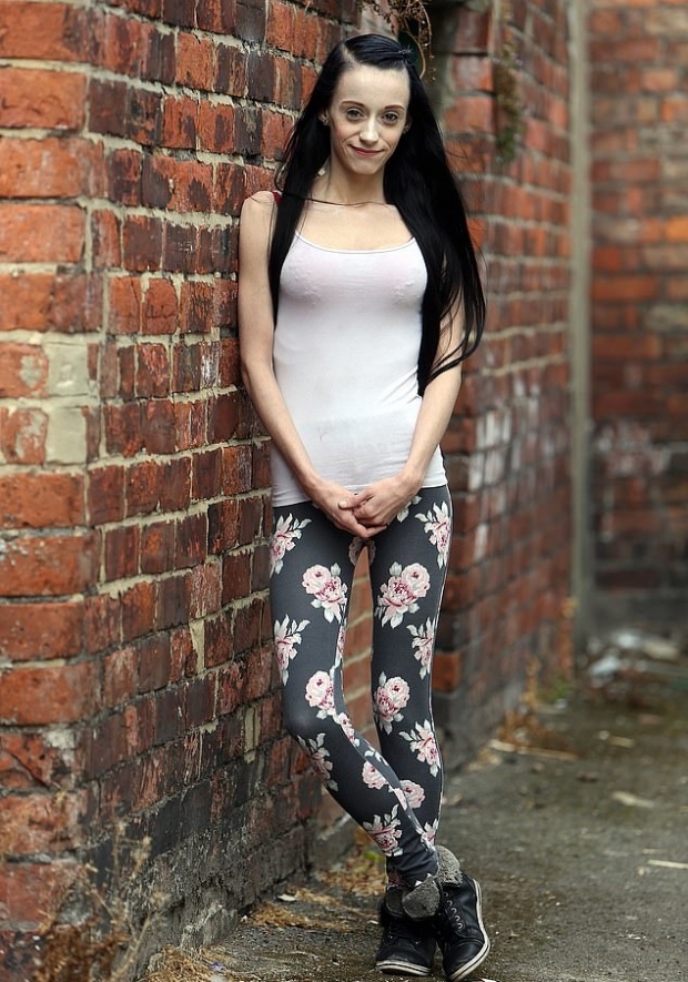 극심한 섭식장애로 실명의 위기까지 온 영국의 미첼라 해리스(26)