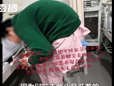 중국의 위 씨(23)가 수술을 받기 전, 강직성 척추염으로 허리를 펴지 못하는 모습