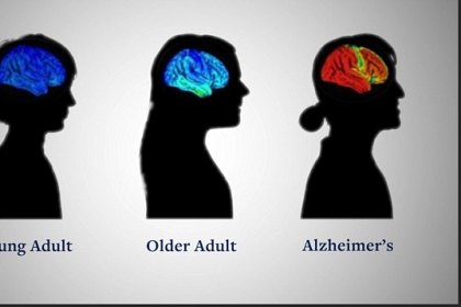 뇌에 전류 흘려 알츠하이머 치료…英 연구팀, 내년 1월 임상시험 시작