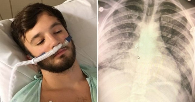 지난해 9월, 가향 전자담배 사용 1년 만에 70대 노인의 폐 상태라는 진단을 받은 미국의 18세 애덤 헤르겐리더